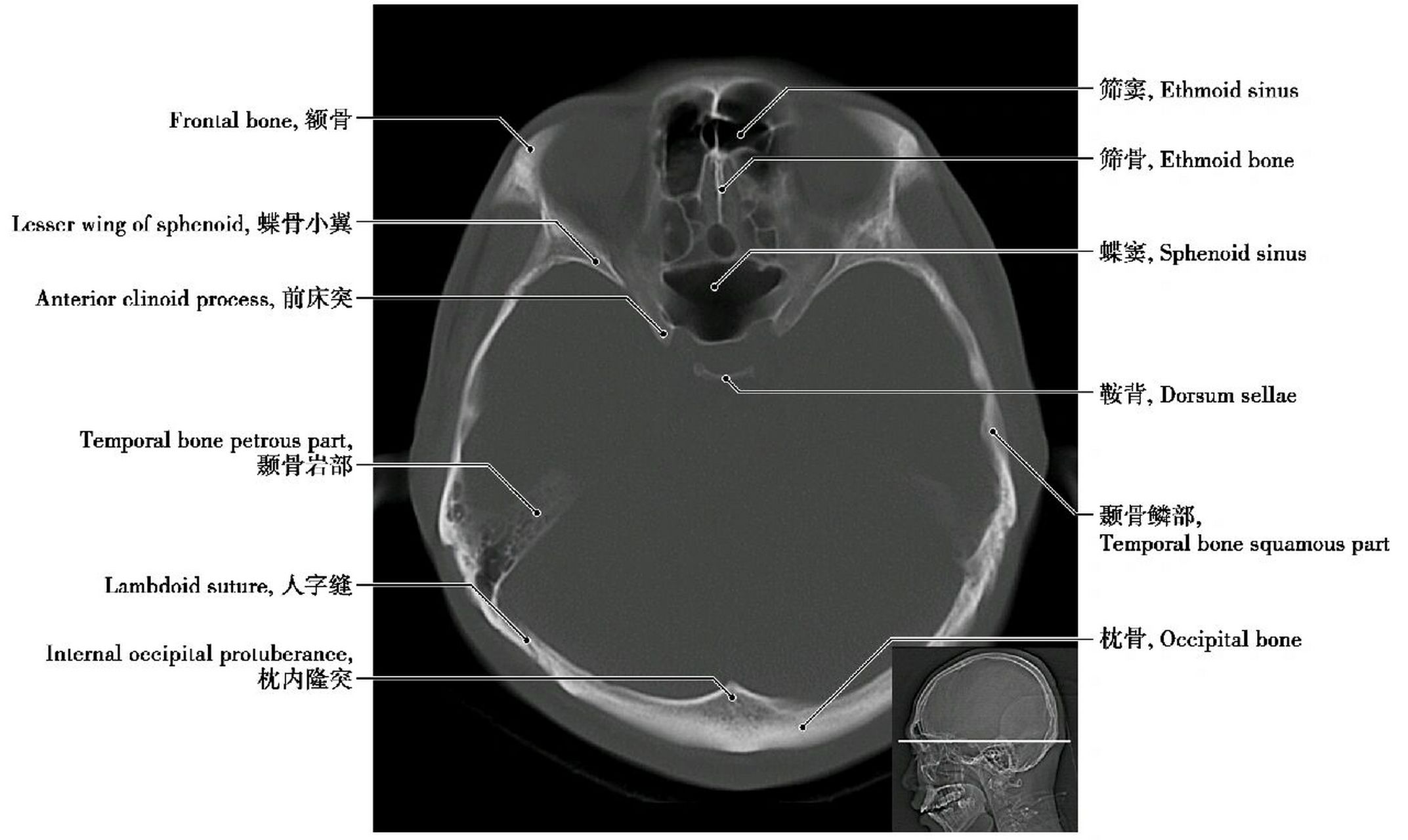 颅骨解剖图ct图片