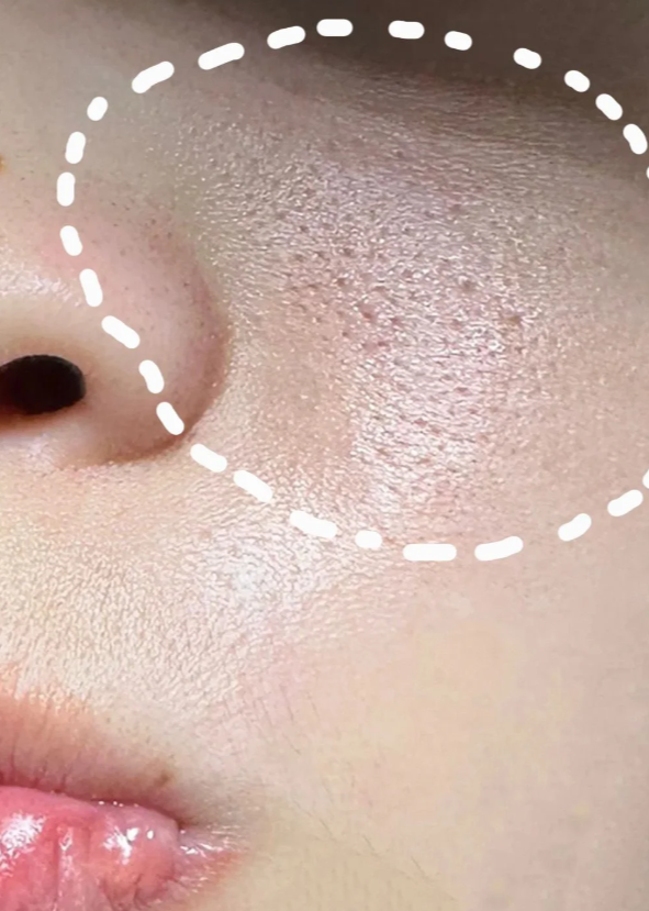 出油型毛孔:出现t字及两颊部位,吃得过于油腻或者出油过剩,容易长痘