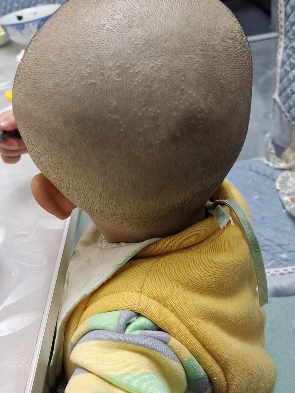 一岁半孩子头上有这种像头皮屑一样的疹子,大概三四天了谁能告诉我这