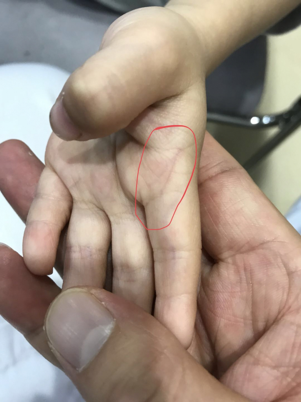 小儿指纹色紫红,家长要当心 小儿指纹的变化可以反映儿童的虚实寒热.