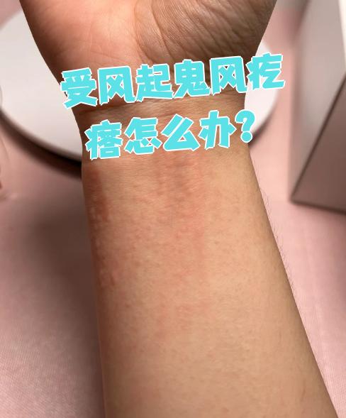 受风起鬼风疙瘩怎么办?