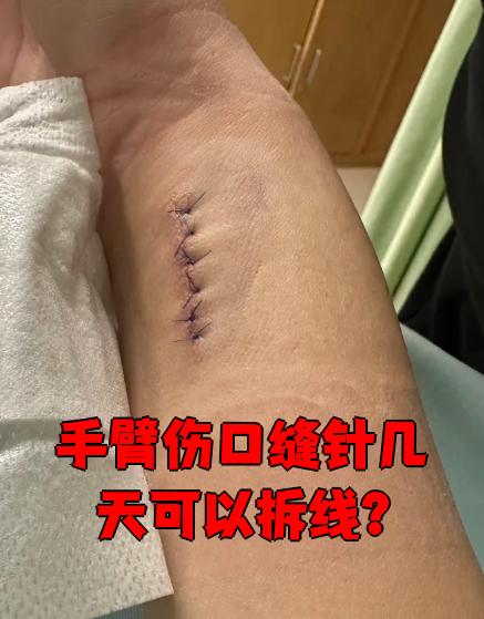 手臂缝针后拆线时间通常是7