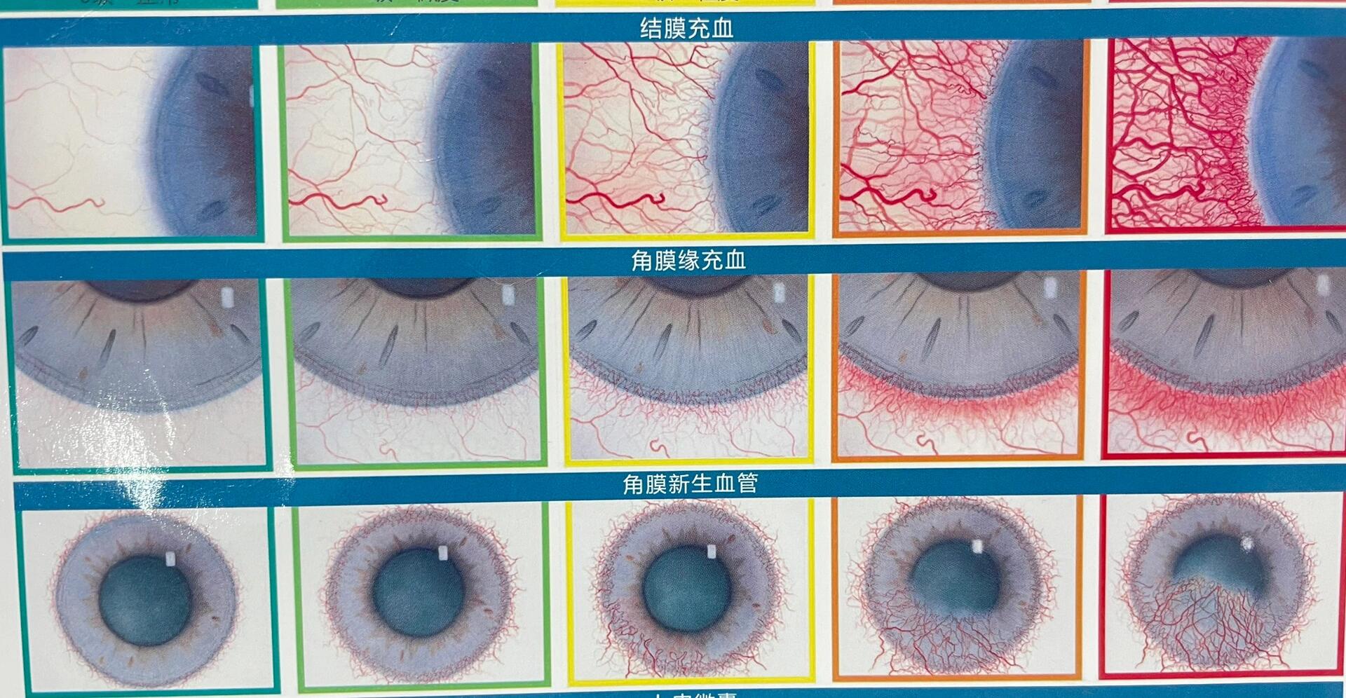 睑结膜充血图片