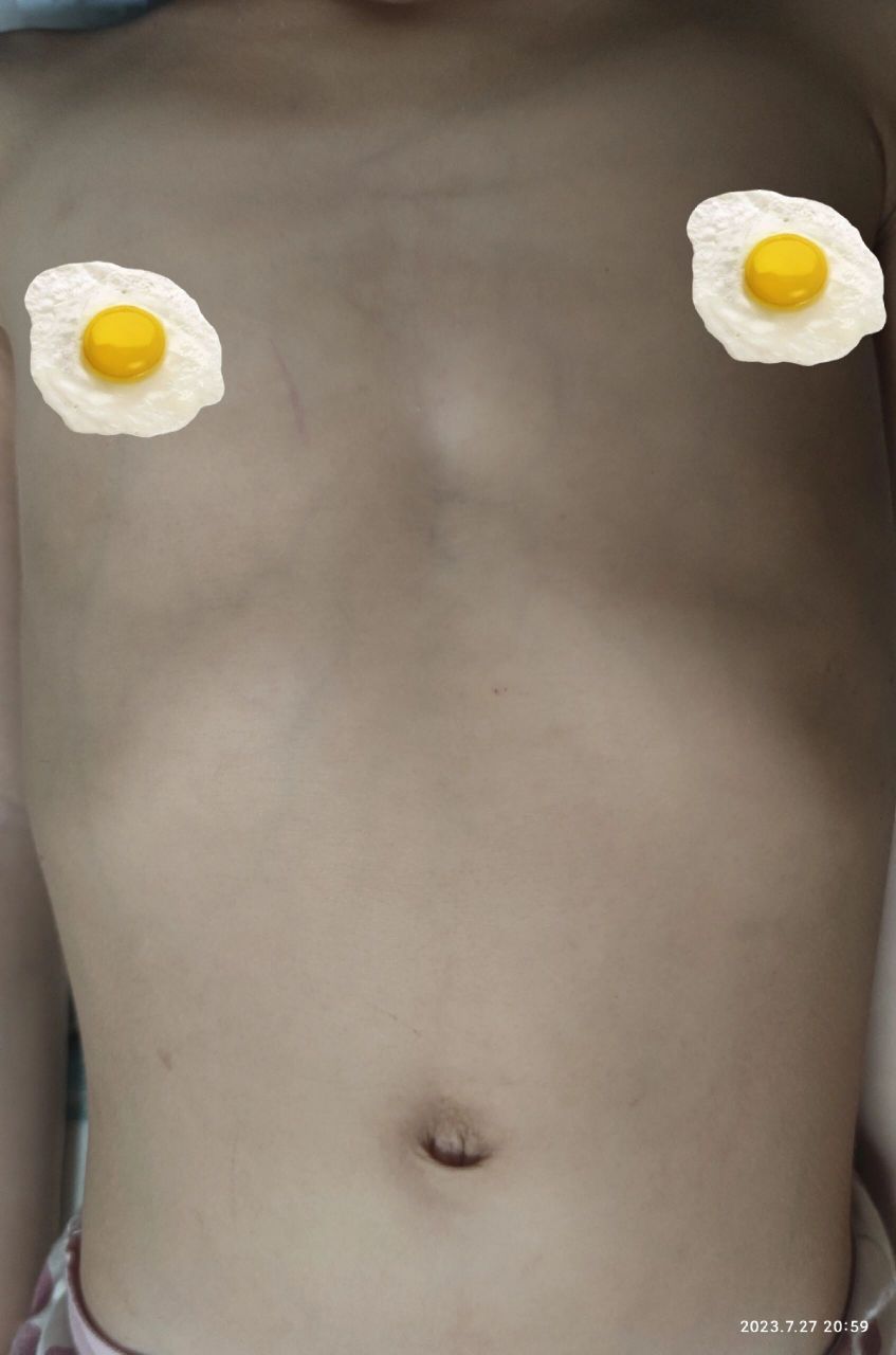 请问这个是儿童鸡胸漏斗胸吗?