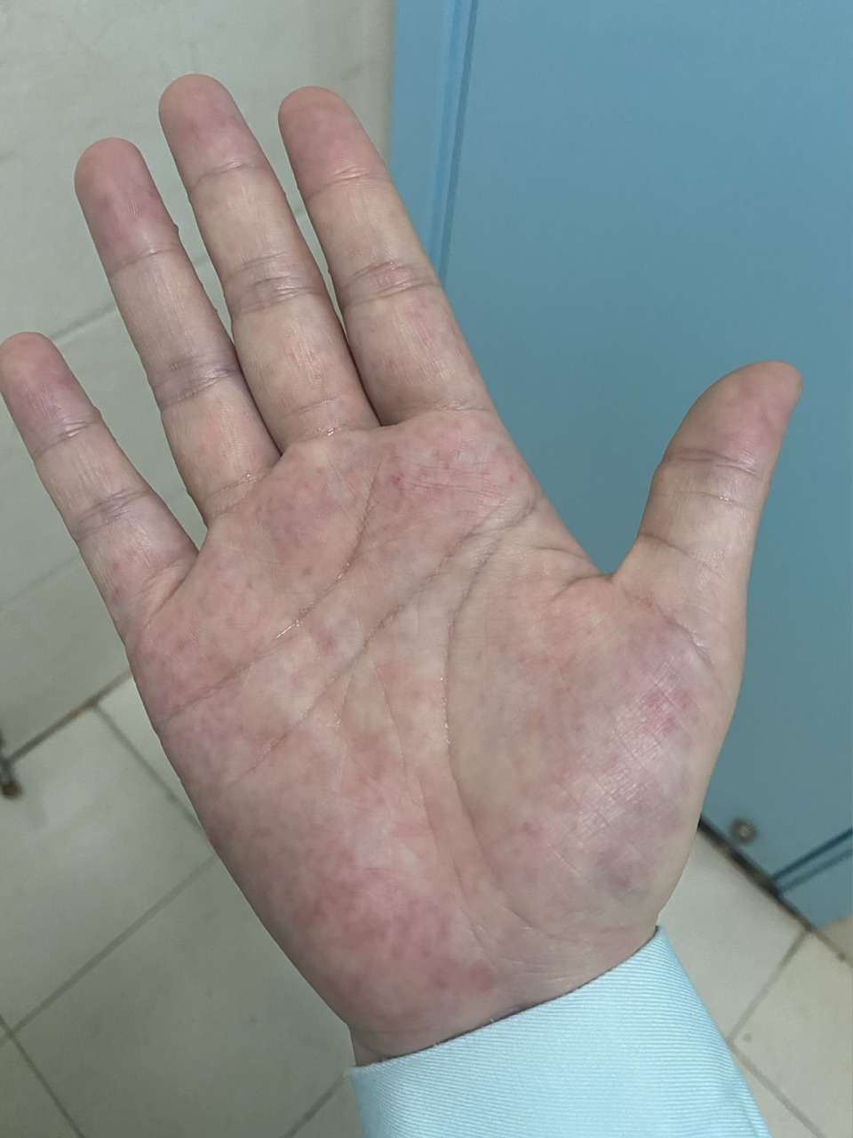 手心红点 手心这样是正常的么,不痛不痒