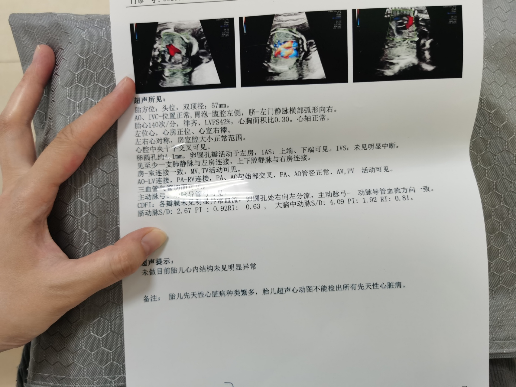 胎儿心脏彩超超声心动图 顺利通过～四维和胎儿超声心动图都是需要