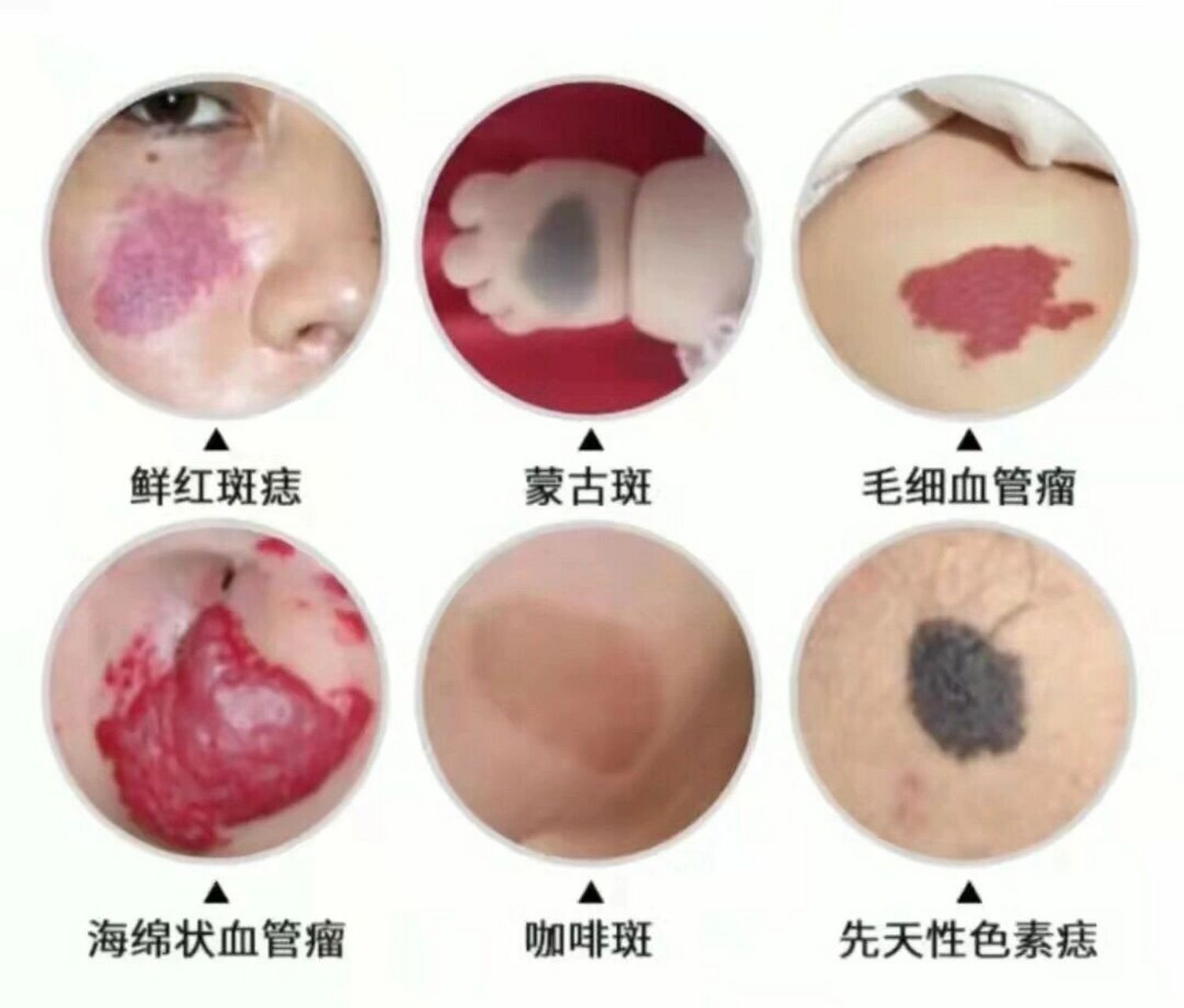 有患者医院就诊,从小就有的一颗黑痣竟然出现溃疡并且身体变差不怎么