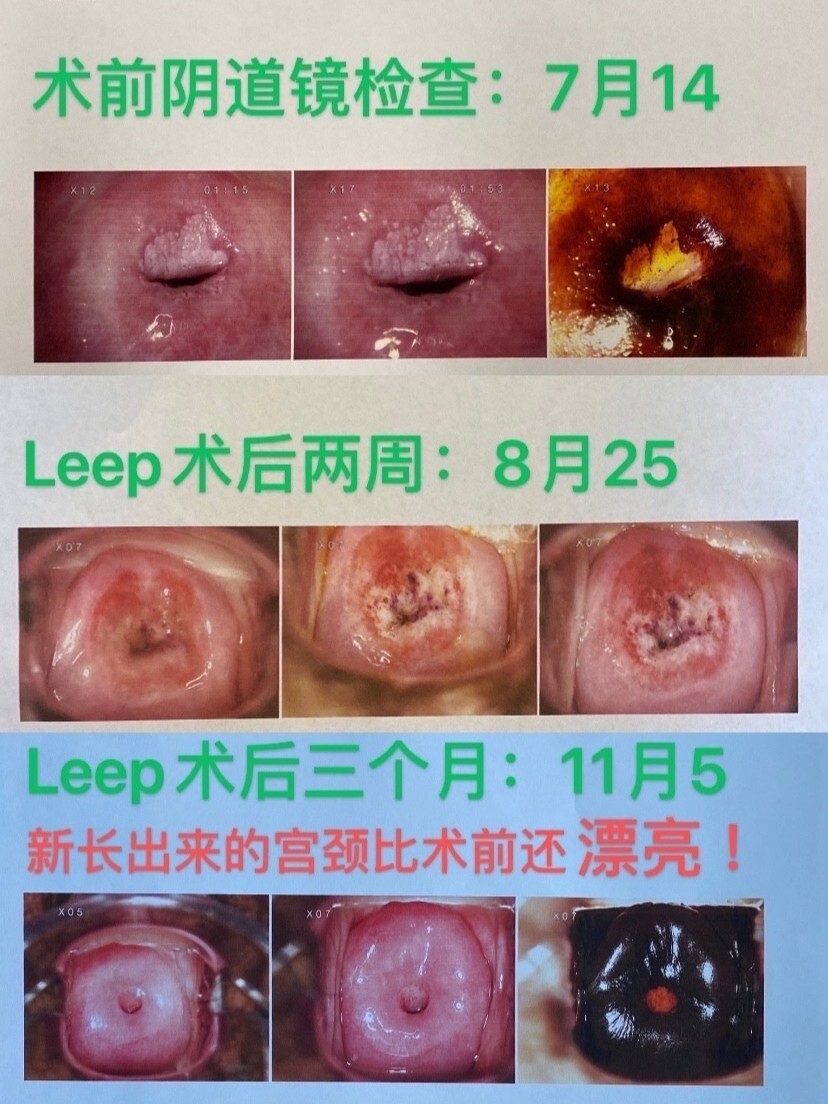 leep术后三个月
