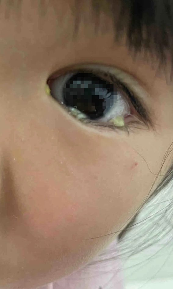 为什么眼睛老是有眼屎