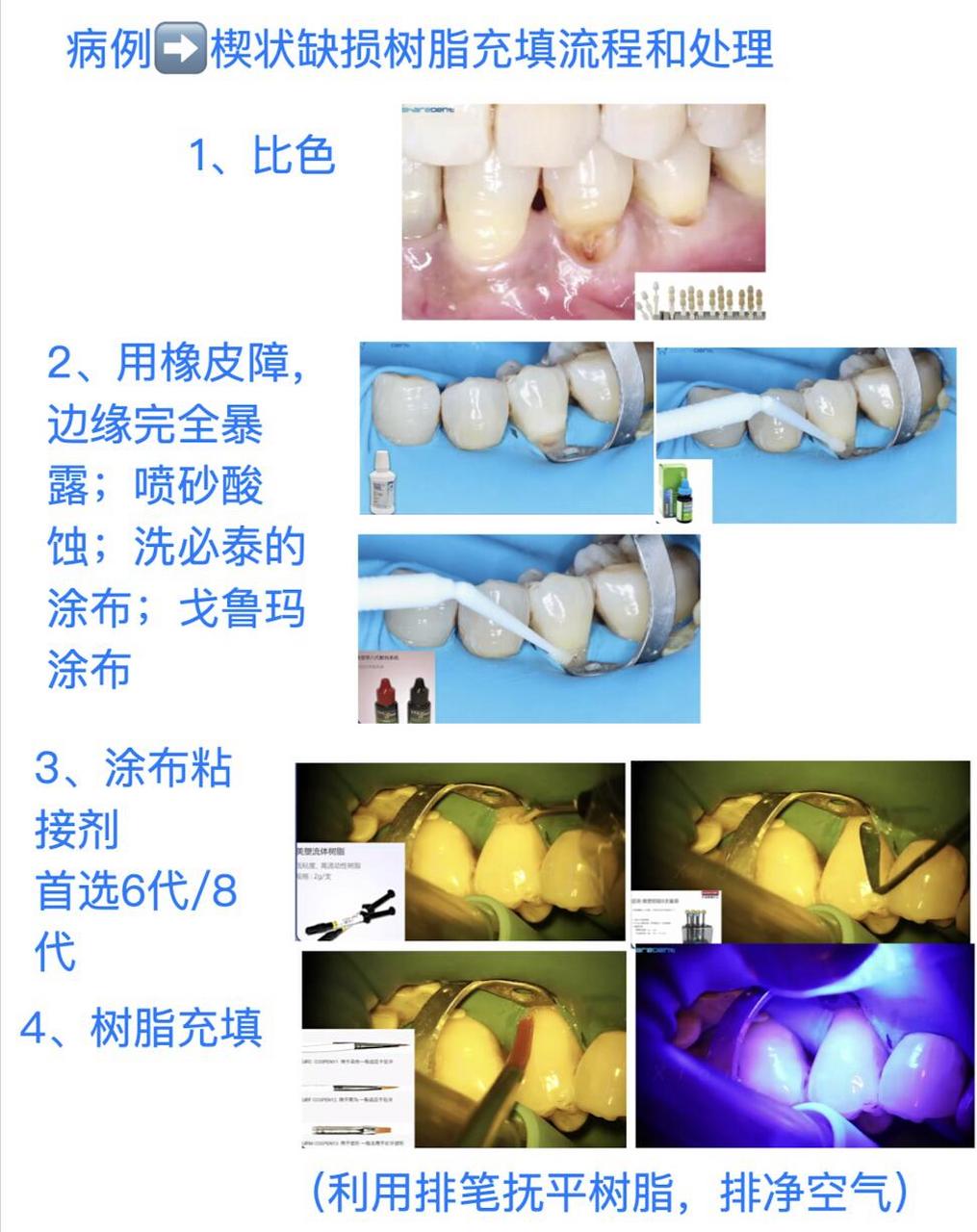 牙齿楔状缺损怎么治疗图片