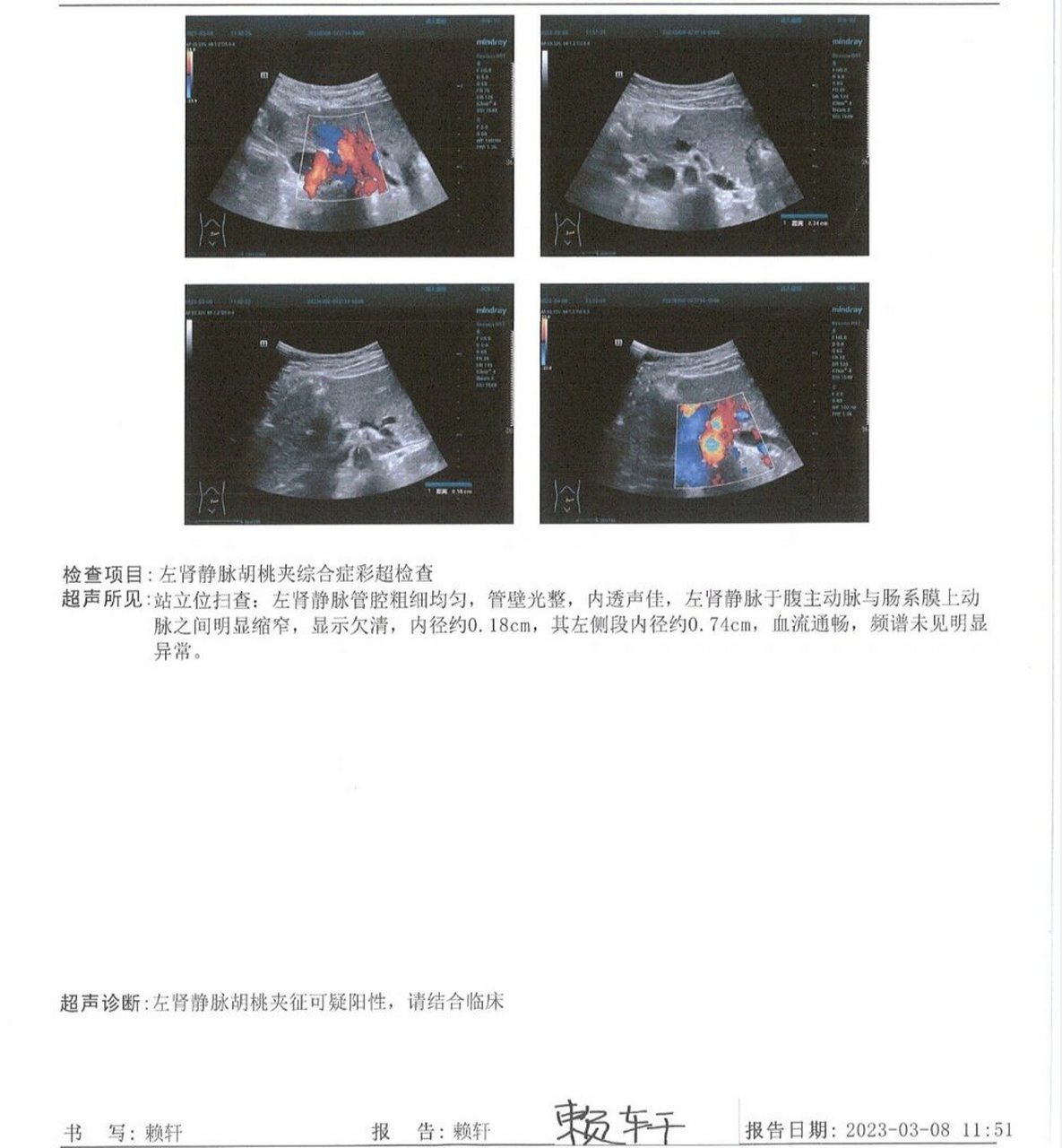 胡桃夹综合征超声诊断图片