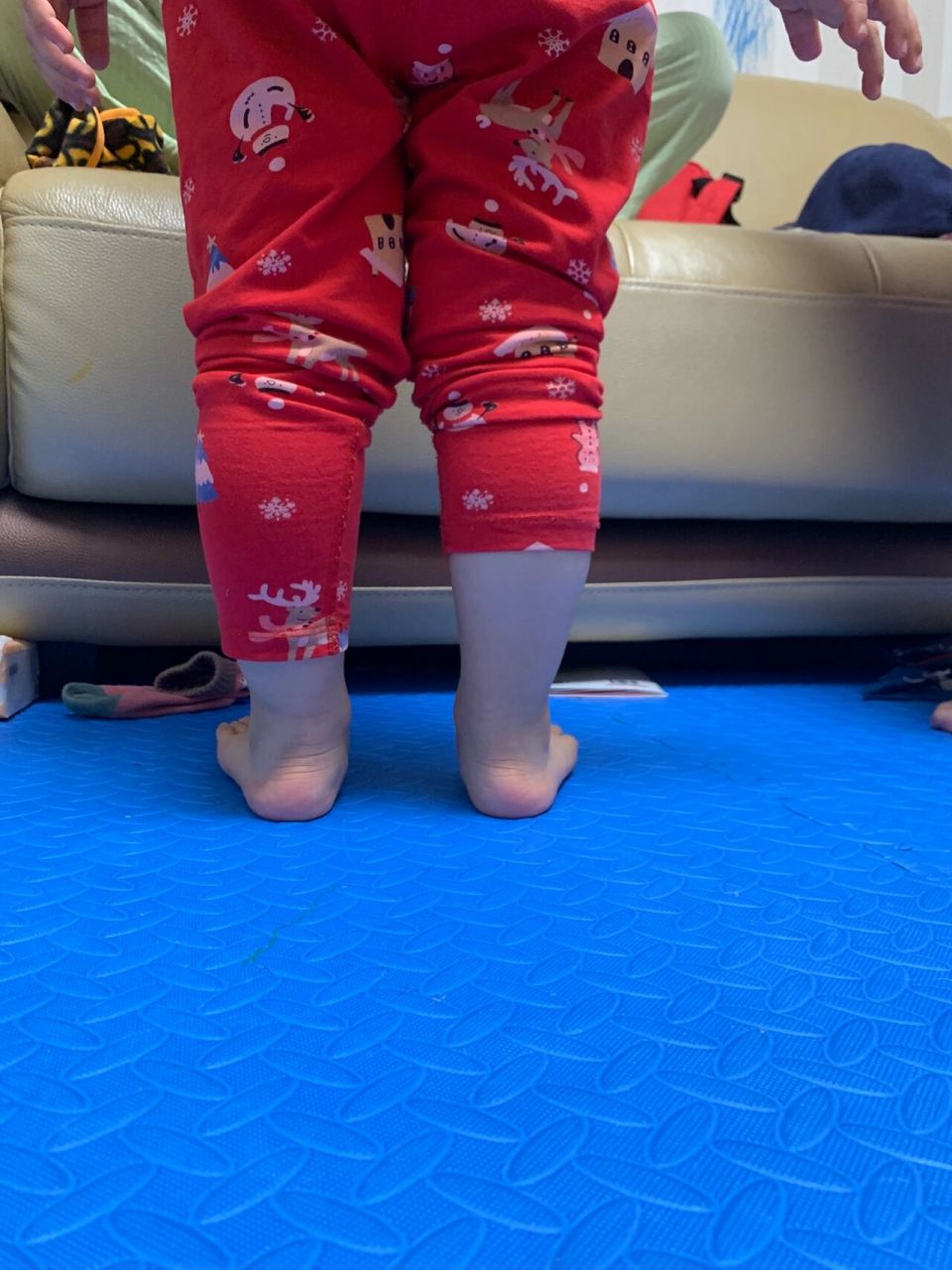 4⃣️【儿童足外翻】娃矫正一年效果  值得期待 铛铛铛铛 写了几