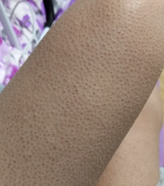 腿起鸡皮疙瘩最常见的原因是皮肤角化异常,环境潮湿或皮肤代谢问题