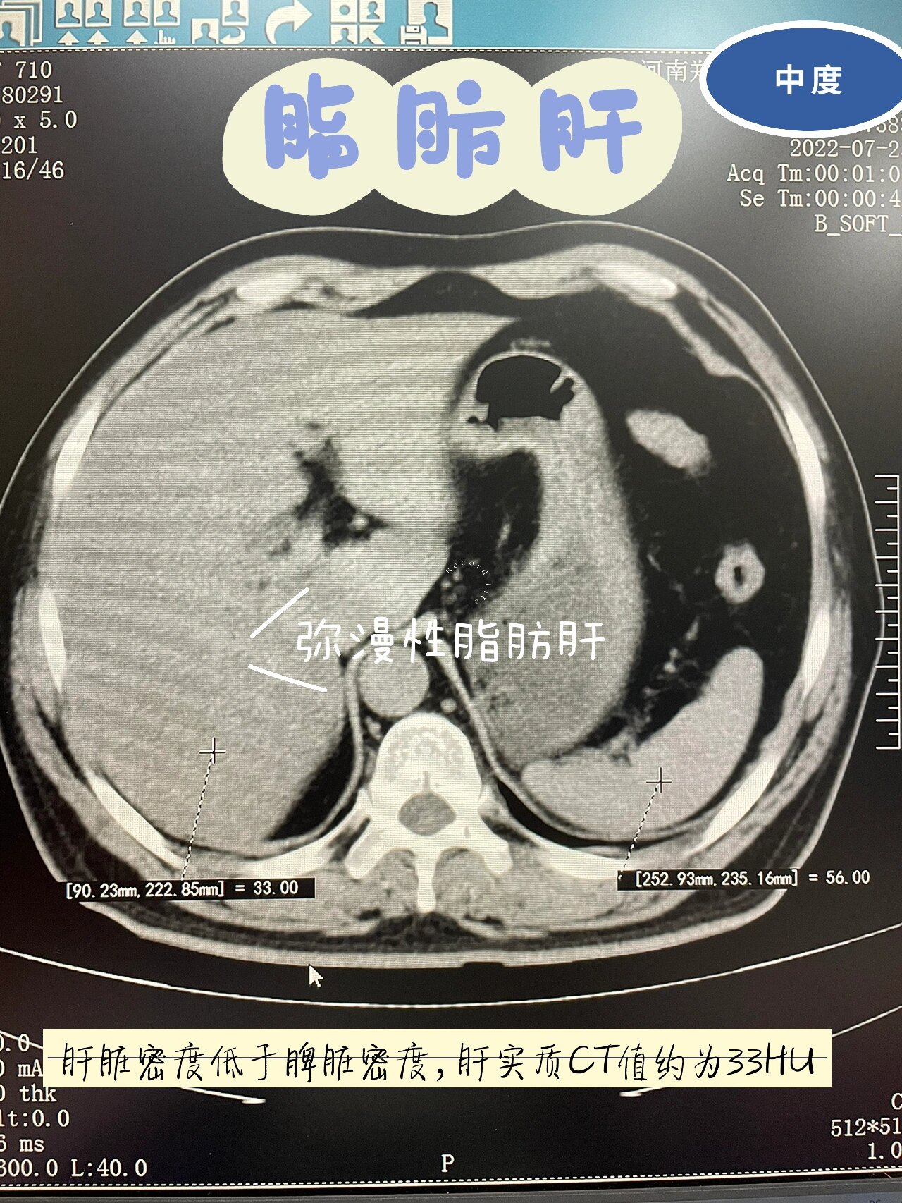 脂肪肝ct表现图片图片