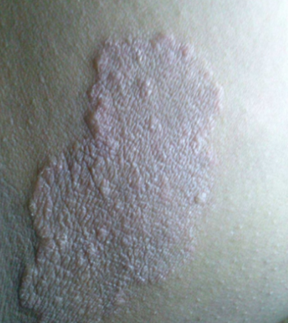 大腿根部内侧长癣样的东西,最常见的是股癣,也可能是湿疹