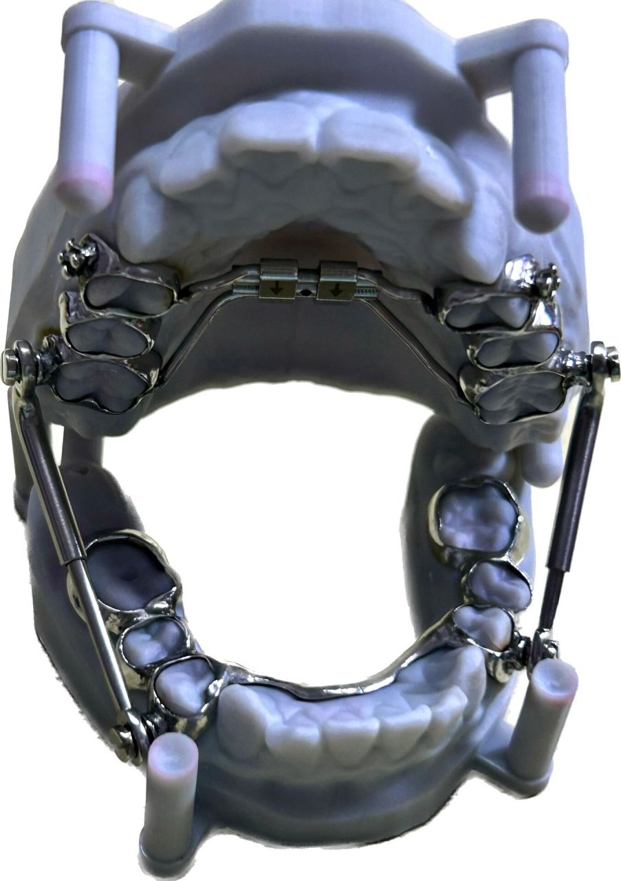 herbst 咬颌前移器(导下颌向前) herbst矫治器,是一种固定的功能性