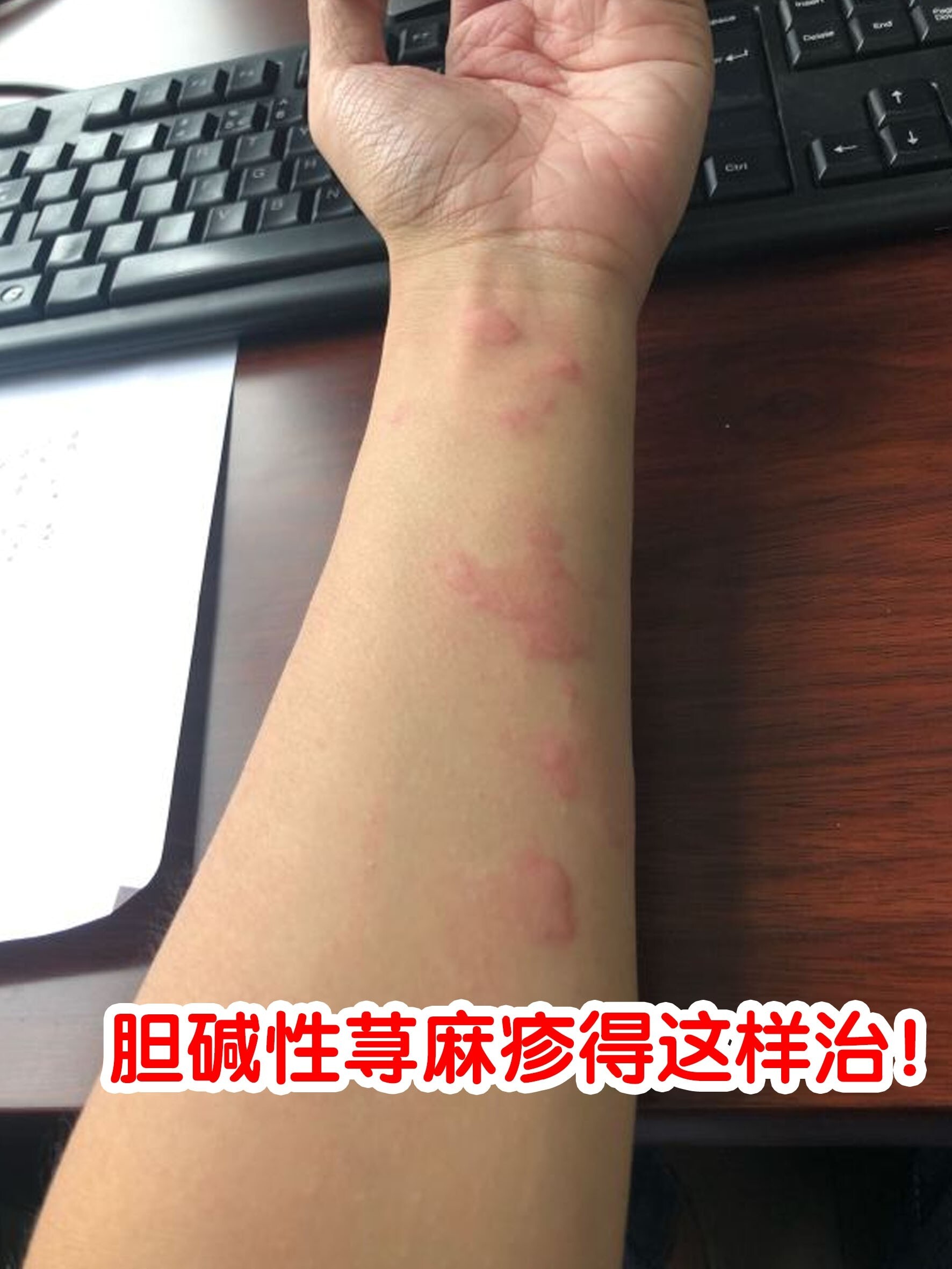 因为一个三年胆碱性荨麻疹患者正在给你讲她的经验! 没错,就是我!