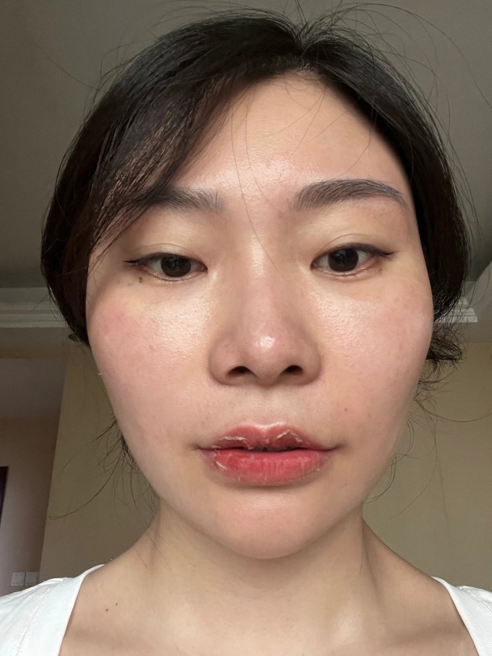 纹唇恢复全过程来啦601560156015 hello,大家好!