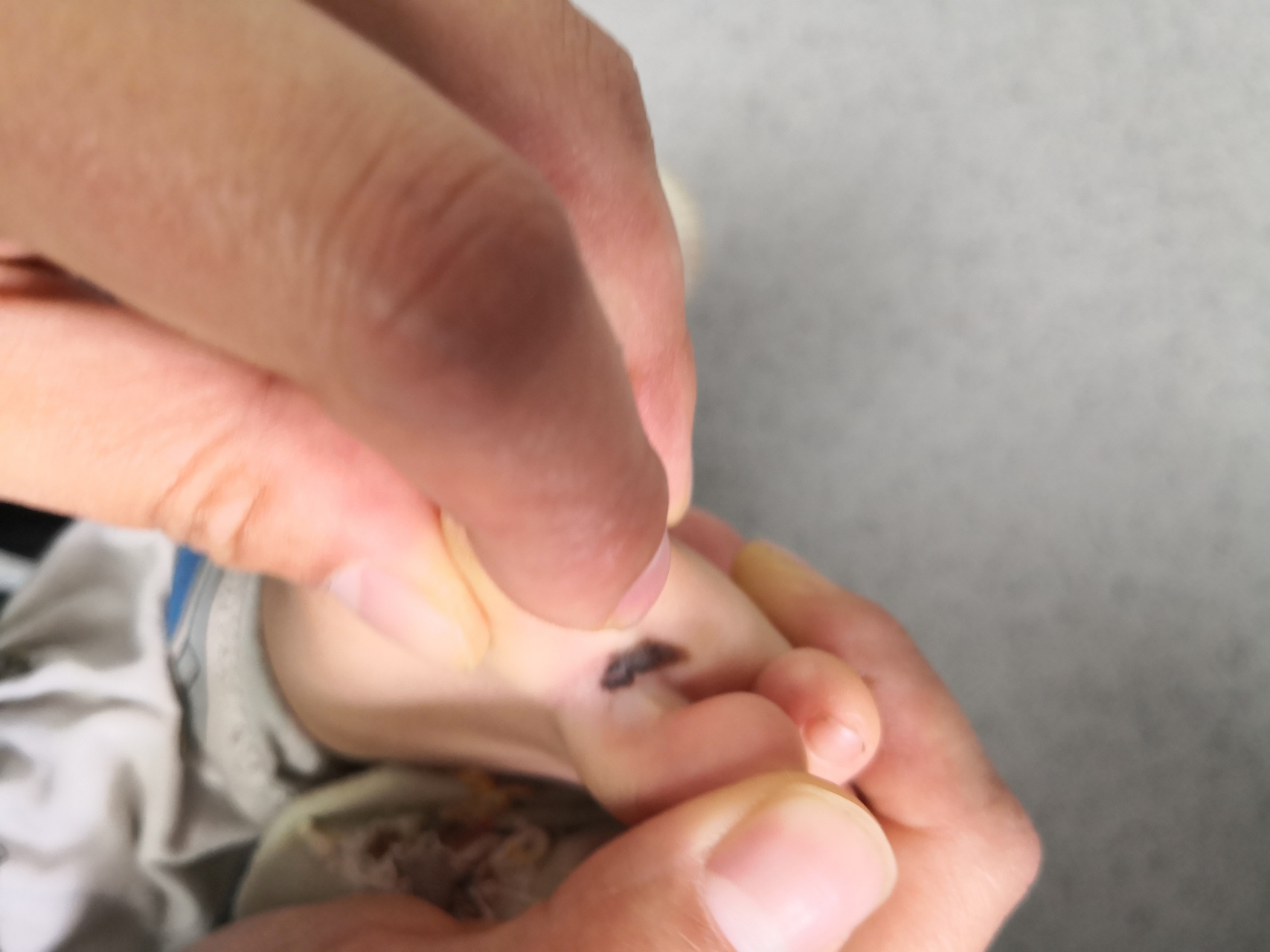 儿童脚趾缝的色素痣症状#手术##色素痣