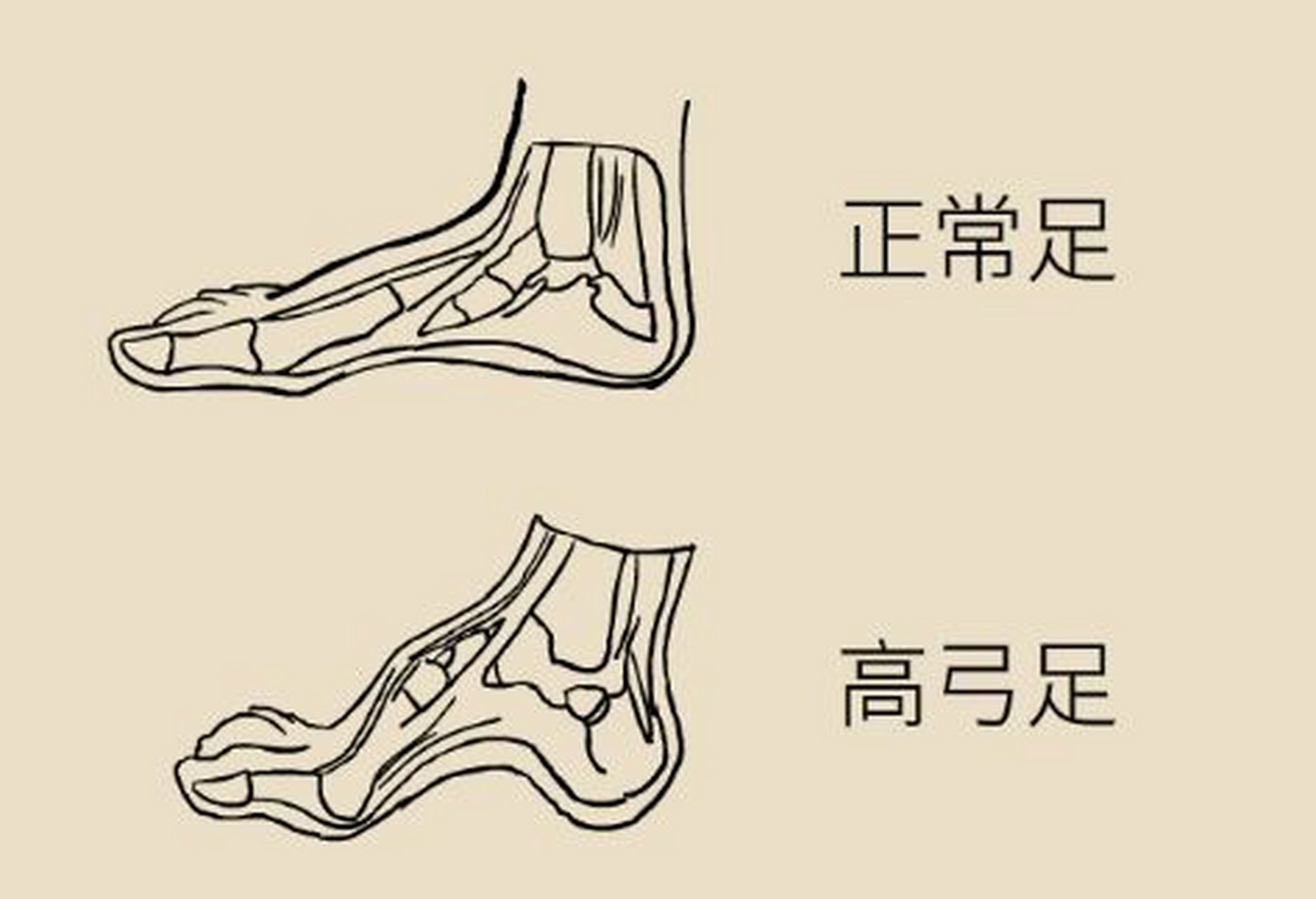 高弓足是一种以足弓较高为主要表现的常见足部畸形.