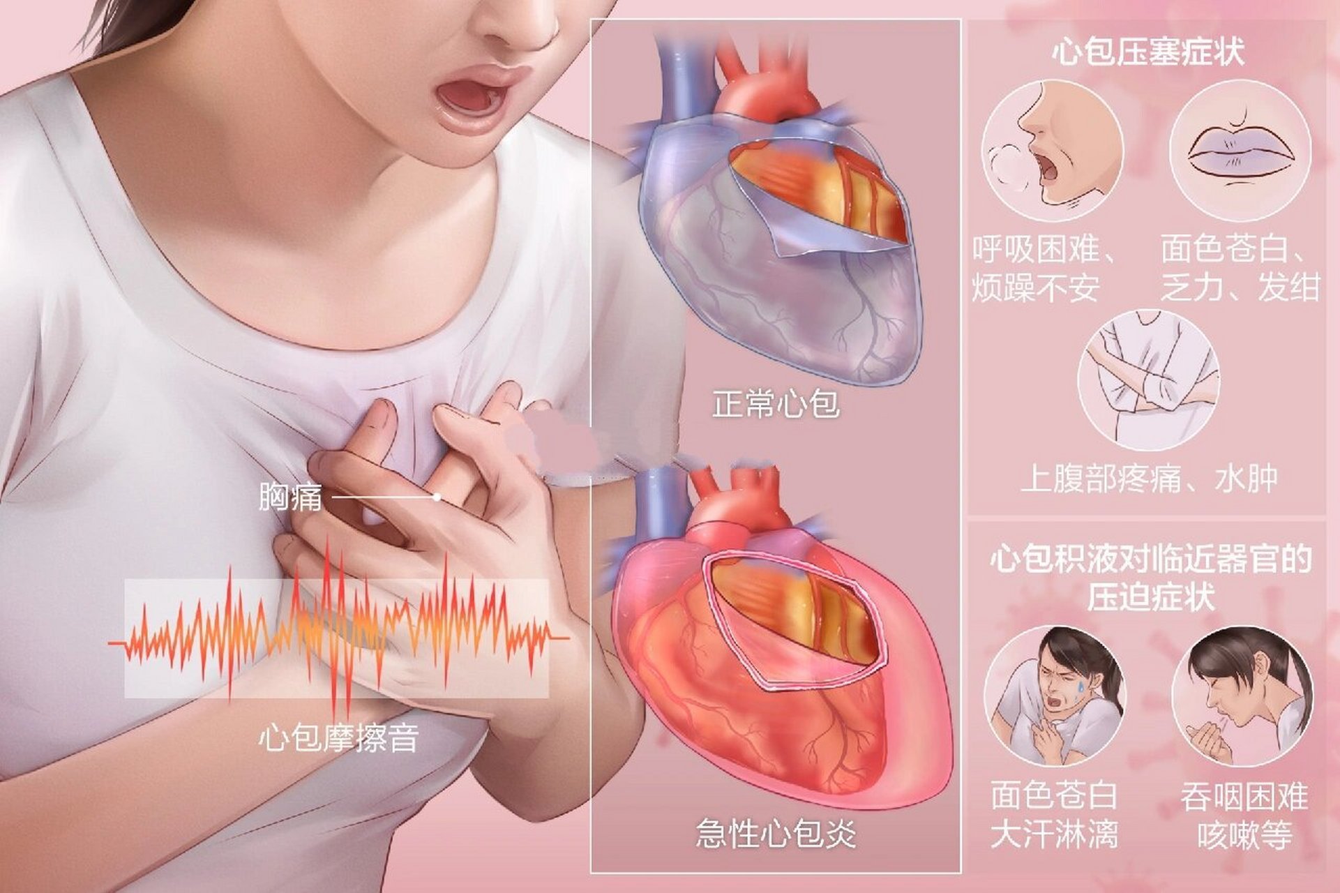 心包脏层和壁层分布图图片