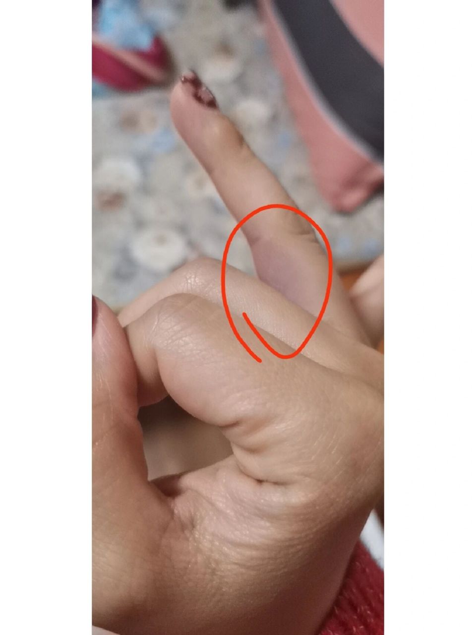 指根发青,不痛不痒,这是怎么回事?