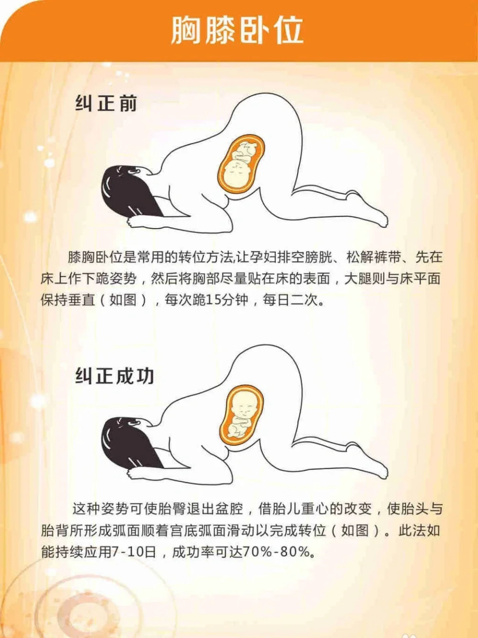 枕后位和枕横位图片图片