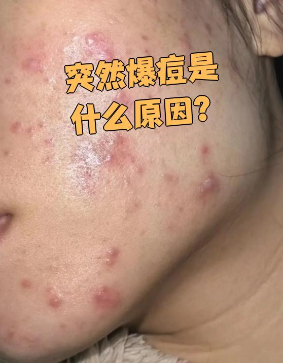 为什么突然冒痘痘 为什么突然冒痘痘