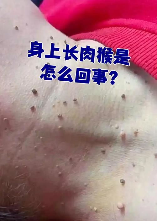 身上长肉猴是怎么回事?