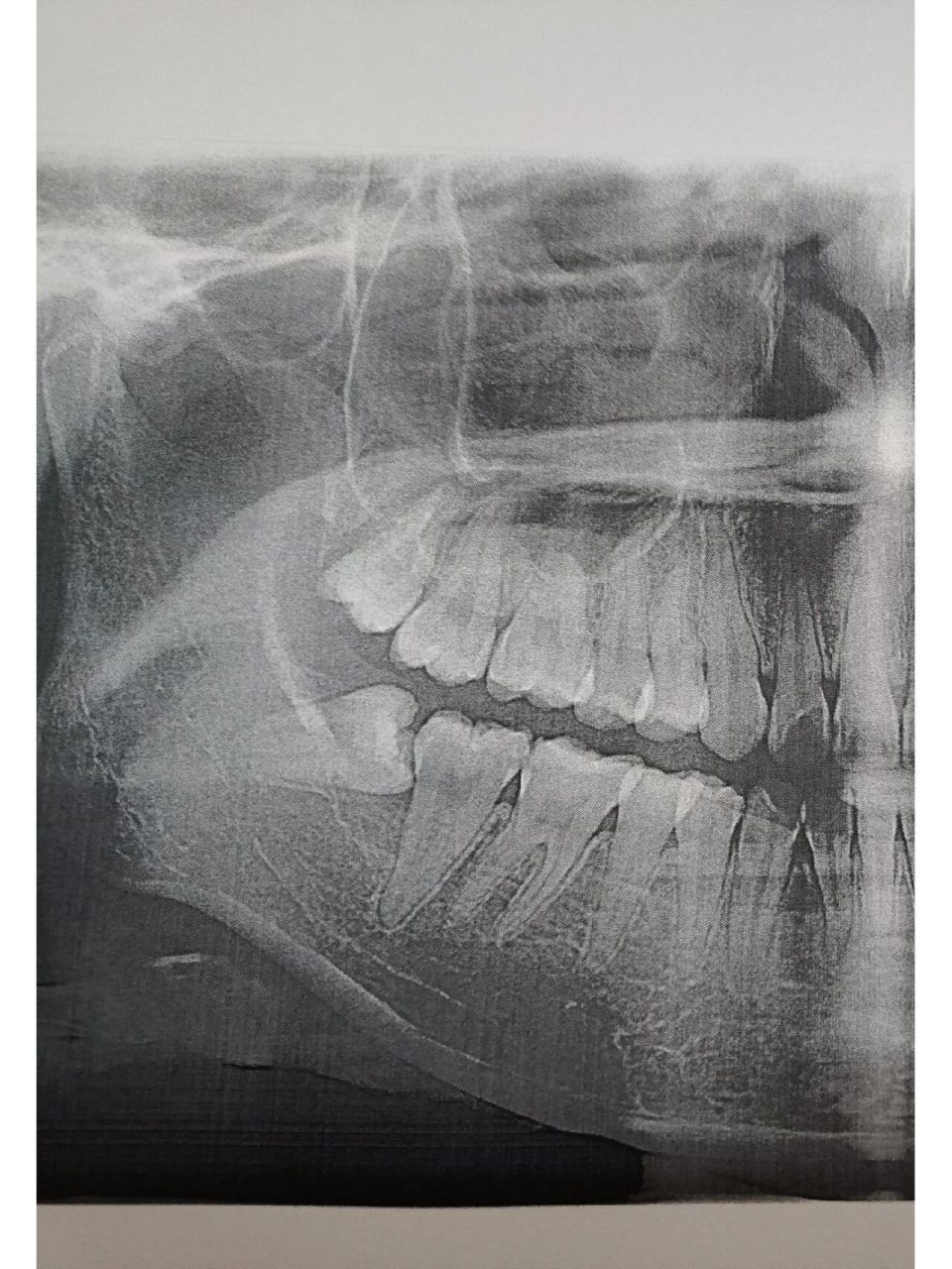 我的智齿长着长着就歪了 p1是六年前的了那时候智齿都还没有长出来 p2