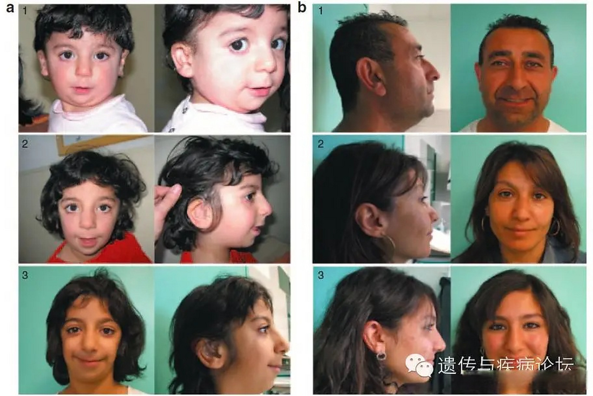 男孩患鸟面综合症#鸟面综合症(treacher-collins综合征)又称颌霉乔