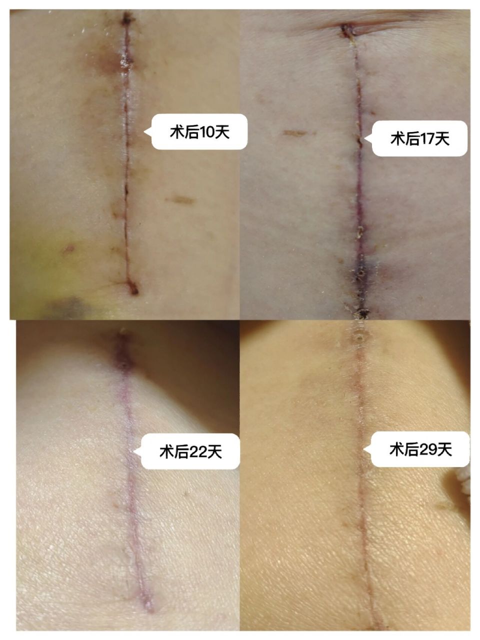 用的是美容线,不用拆线,术后第二天换药一次,术后10天后揭开.