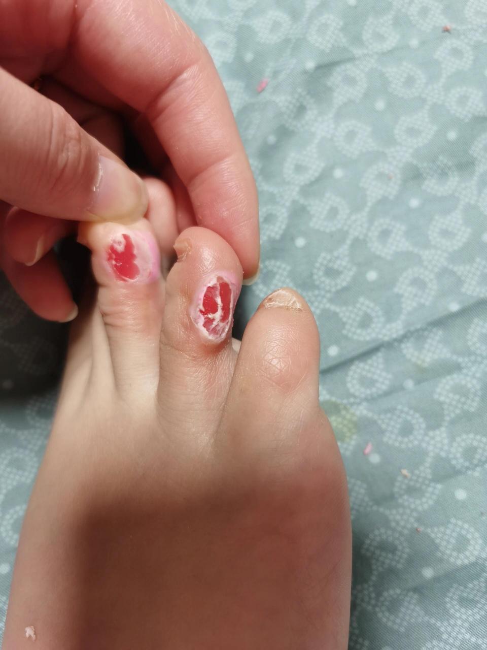 用了两天鸡眼贴感觉不是鸡眼是老茧… 大概几年前最后一个脚趾缝里长