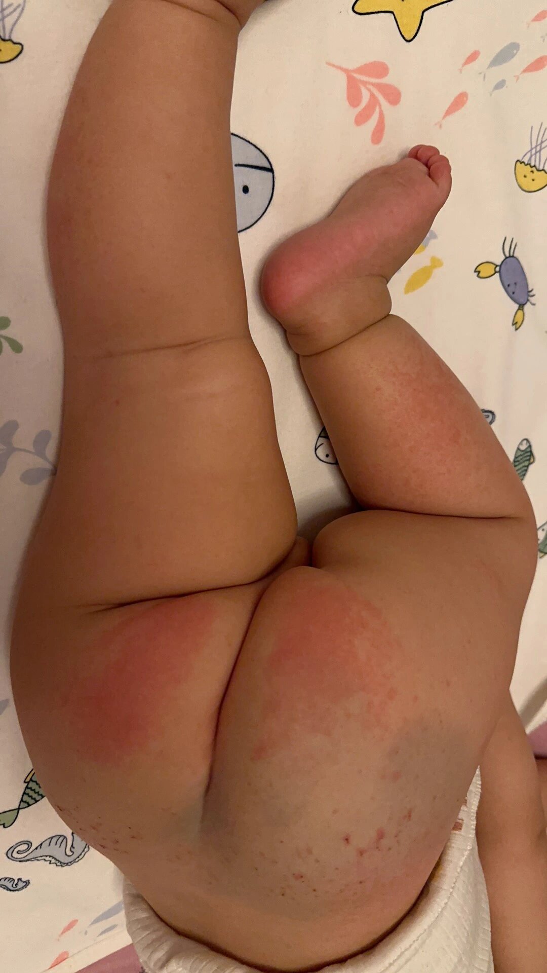 宝宝屁股红 原来是这个原因