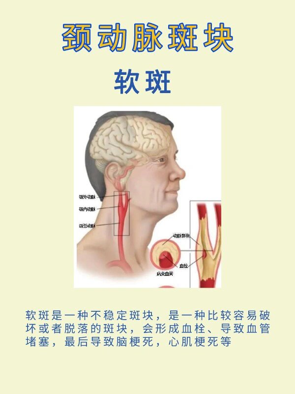 颈动脉斑块图片及说明图片