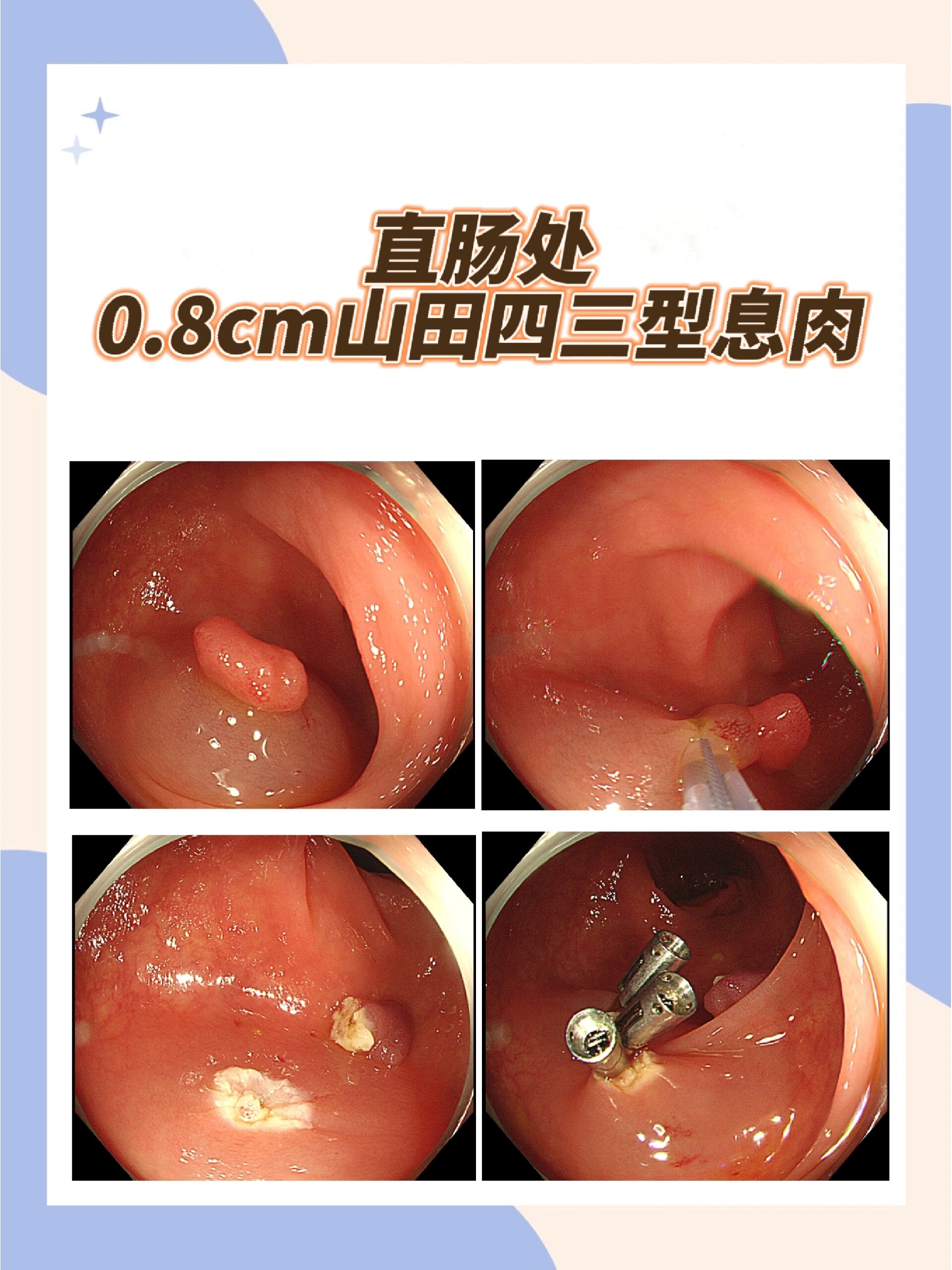 山田3型息肉图片