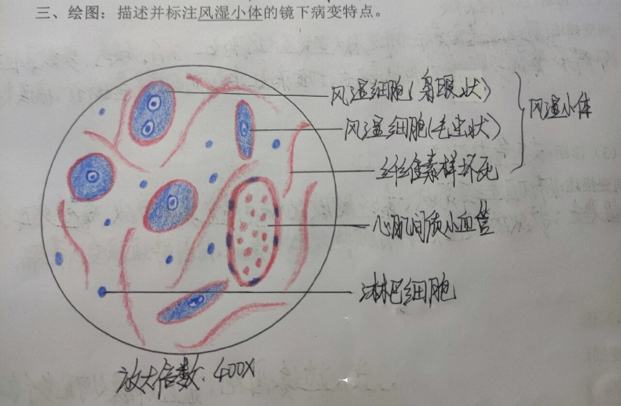 病理学┃心血管疾病┃风湿小体