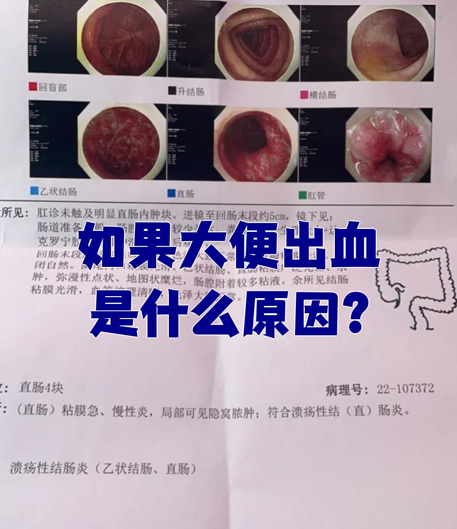 潍坊痔疮医院：专业治疗，呵护每一份健康