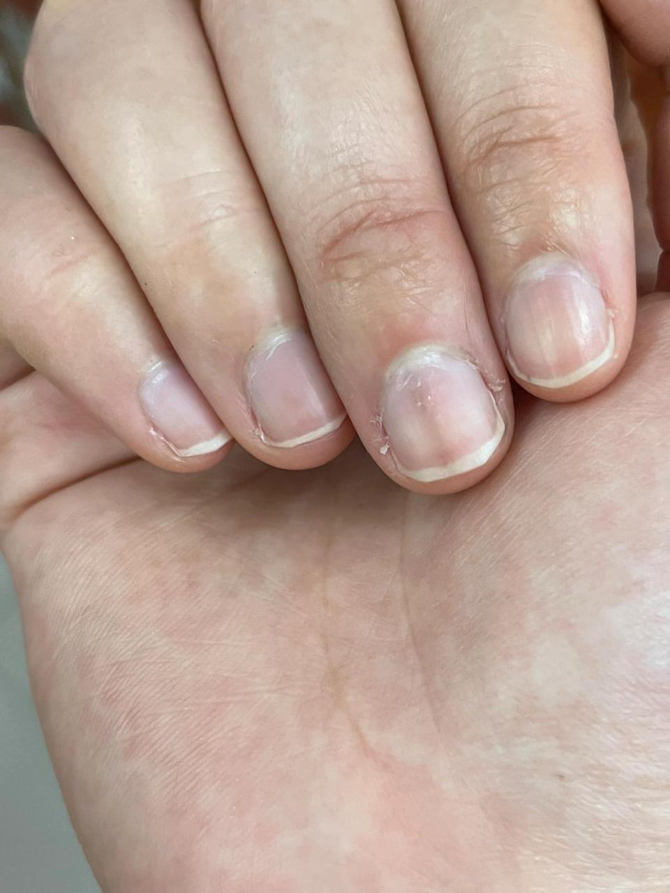 手甲上有黑线是什么回事 大拇指的黑线好几年了,最近另一个手中指也