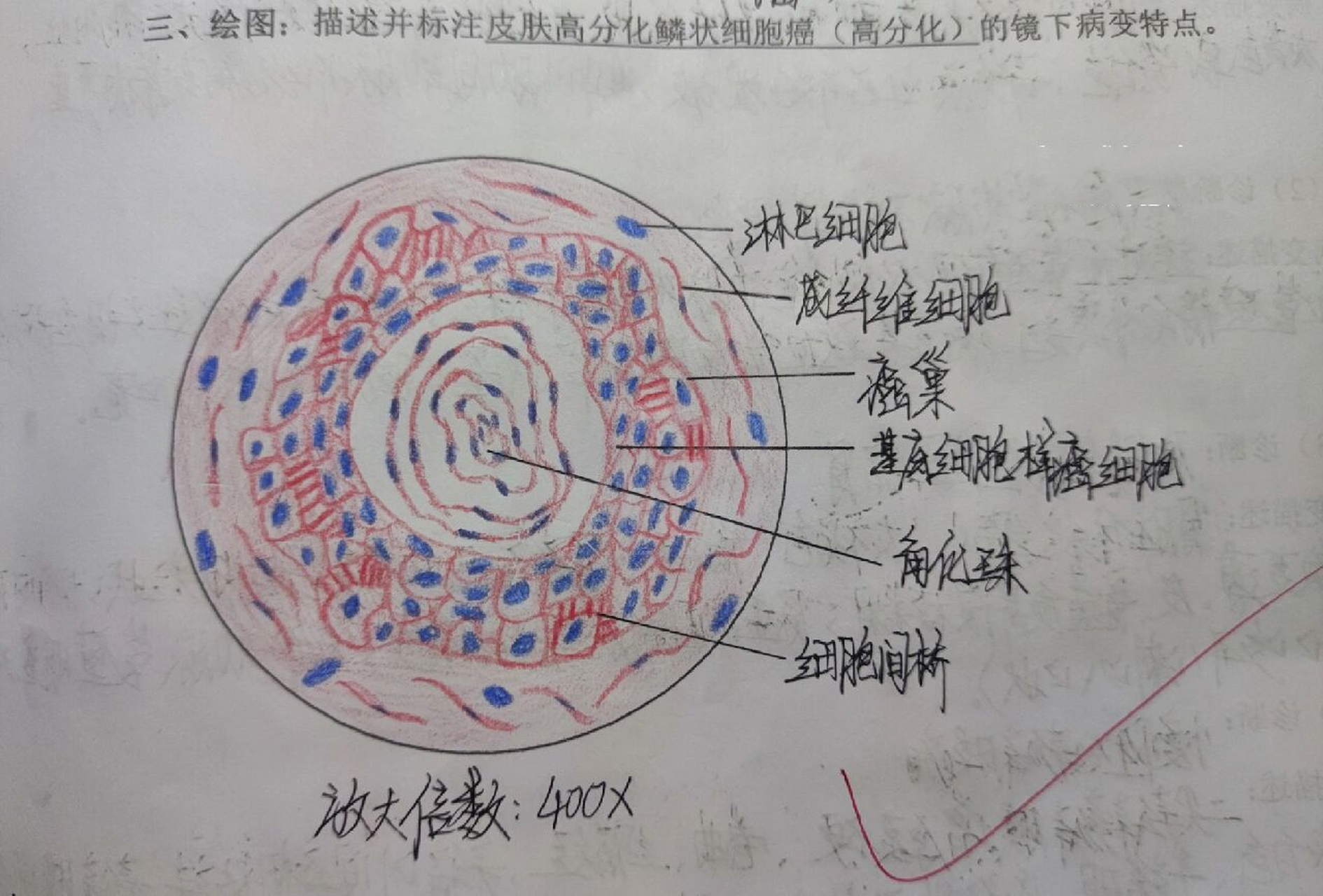 病理学红蓝铅笔绘图(全) ①肾近曲小管上皮细胞水肿 ②肺动脉内混合