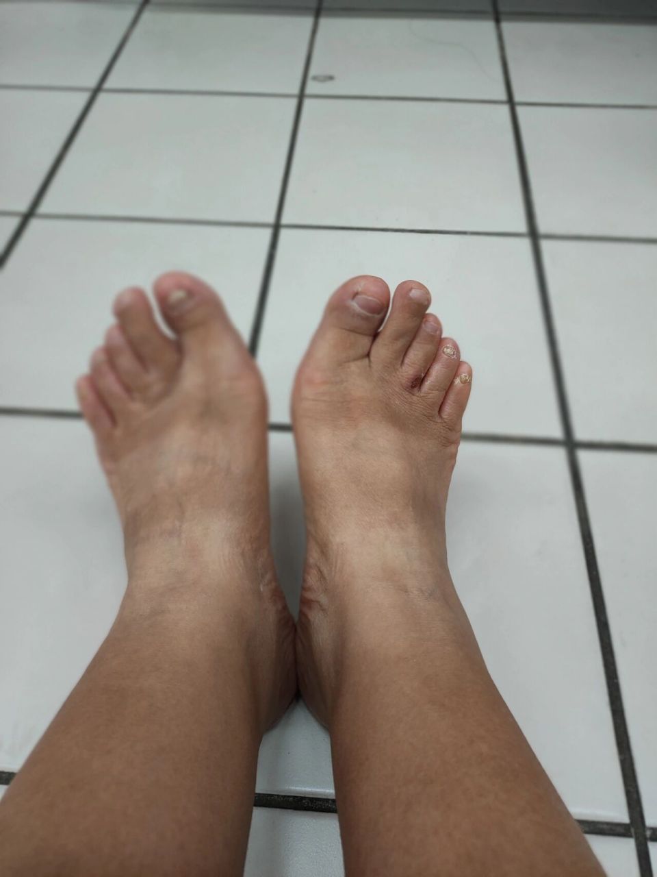 世界上最丑的脚~ 这么丑的脚,还有救嘛?