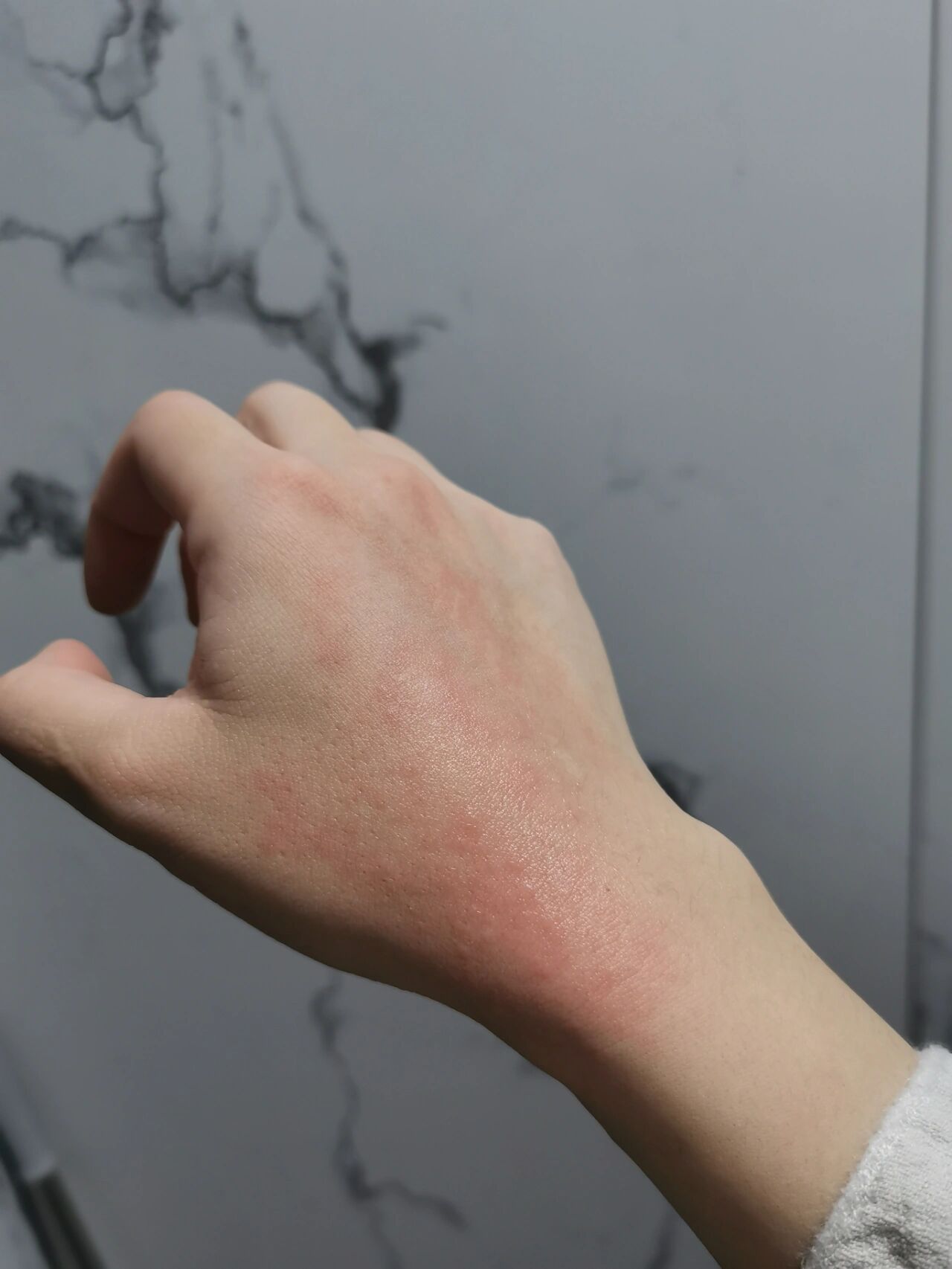 手背突然长很多小疹子,一开始没在意,碰到热水或者热气烘一下,红疙瘩