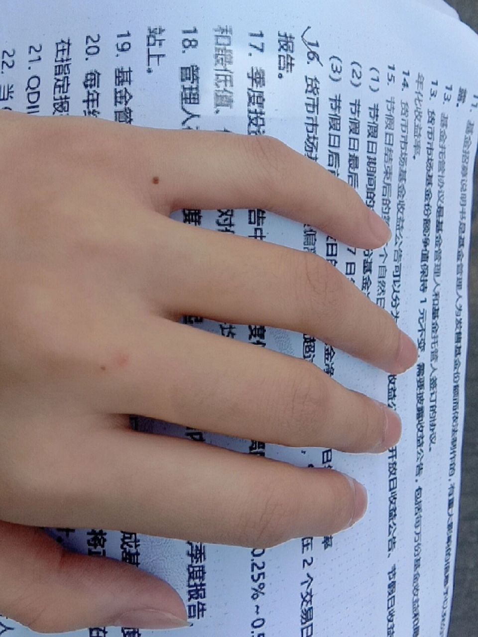 手上长了颗痣,不知道要不要处理掉 备考基金但完全不想看