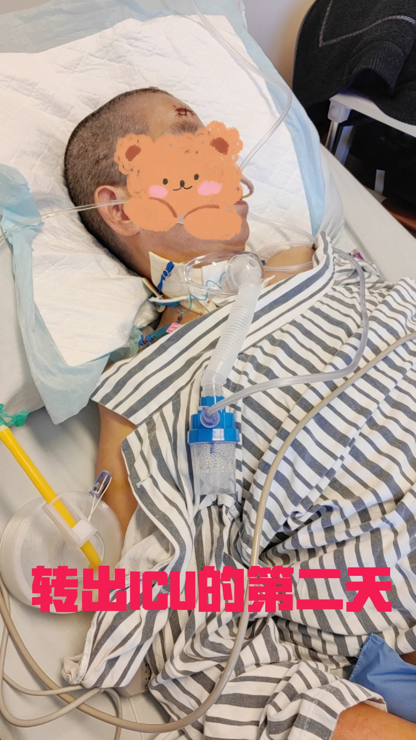 "气切"昏迷病人如何照顾