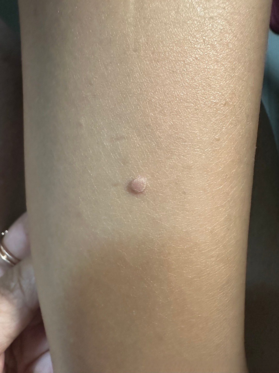 小腿长了一个肉疙瘩,感觉越长越大,长得比较快 好想有一个多月了,不疼