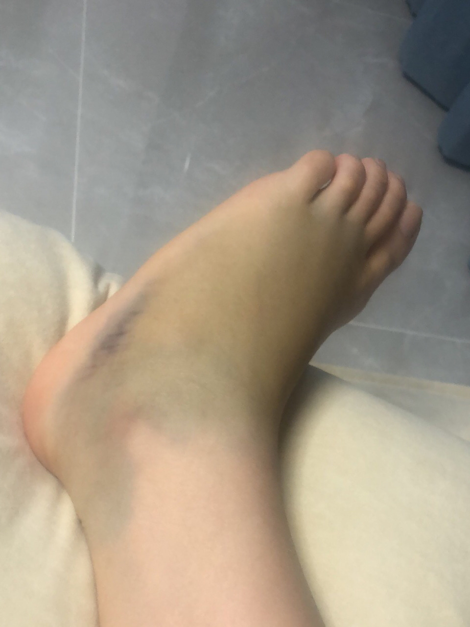 第五跖骨骨折 晚上在家楼下散步,平地崴脚,当时脚已经无法踩在地板上