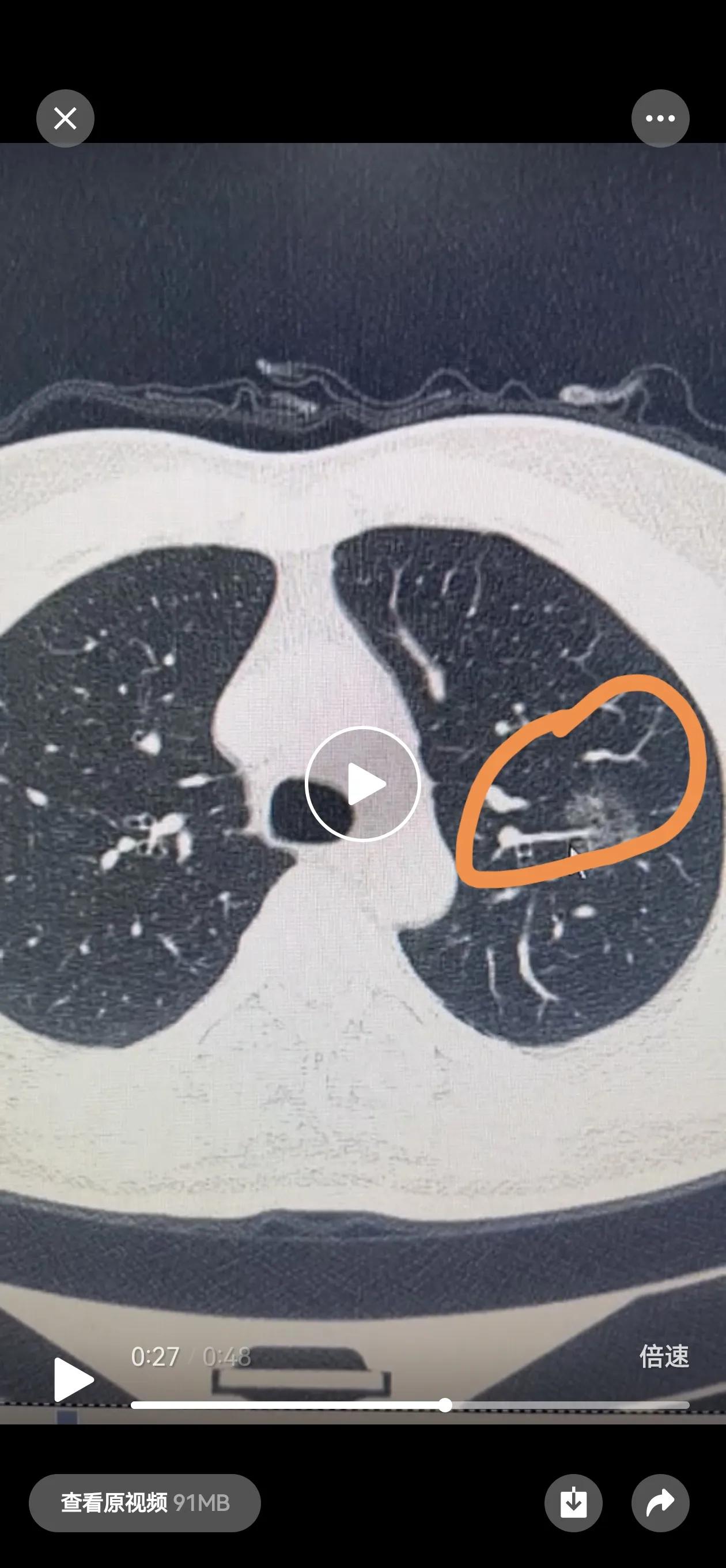 肺结节是影像学检查中常见的发现,多数为良性,但部分可能为早期珐癌