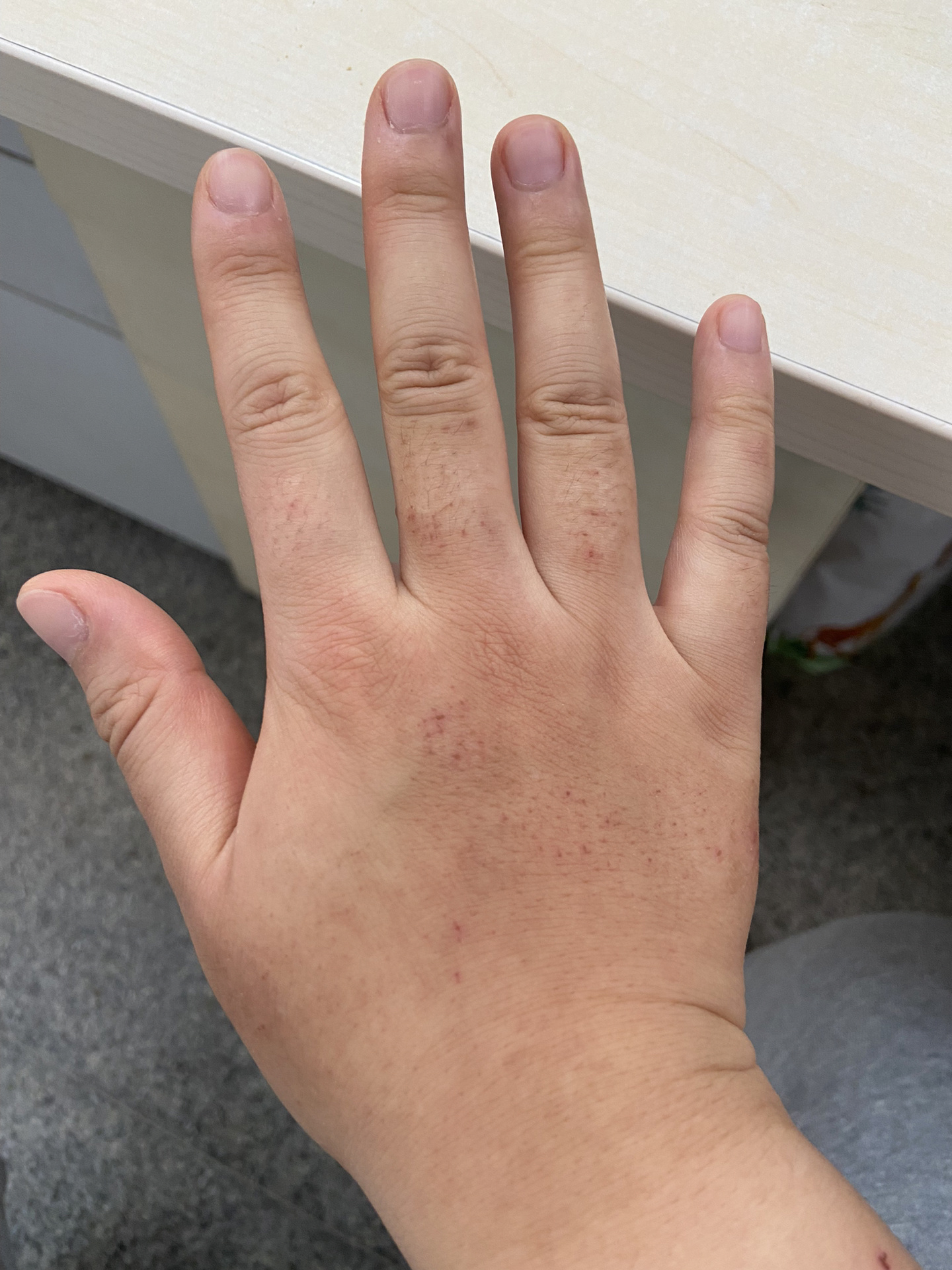 冬天手背起疙瘩有救了