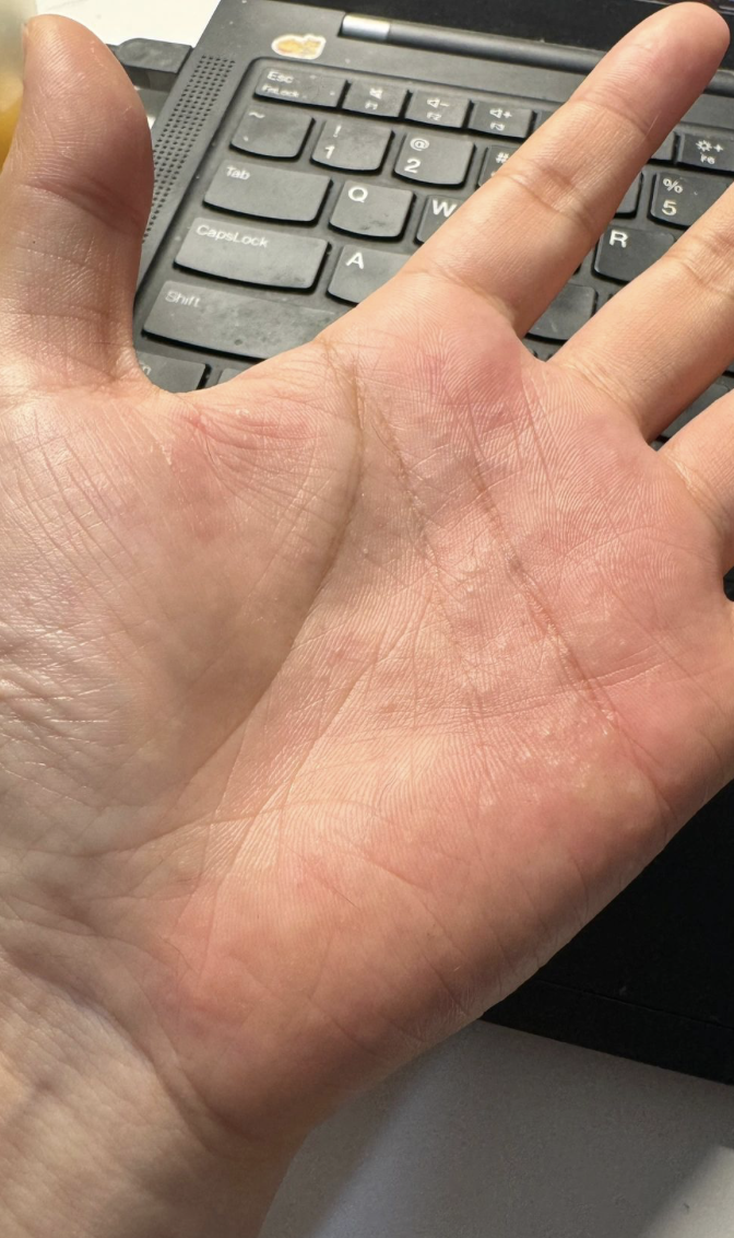 手心痒可能和日常接触的东西有关,也可能是皮肤疾病引起的