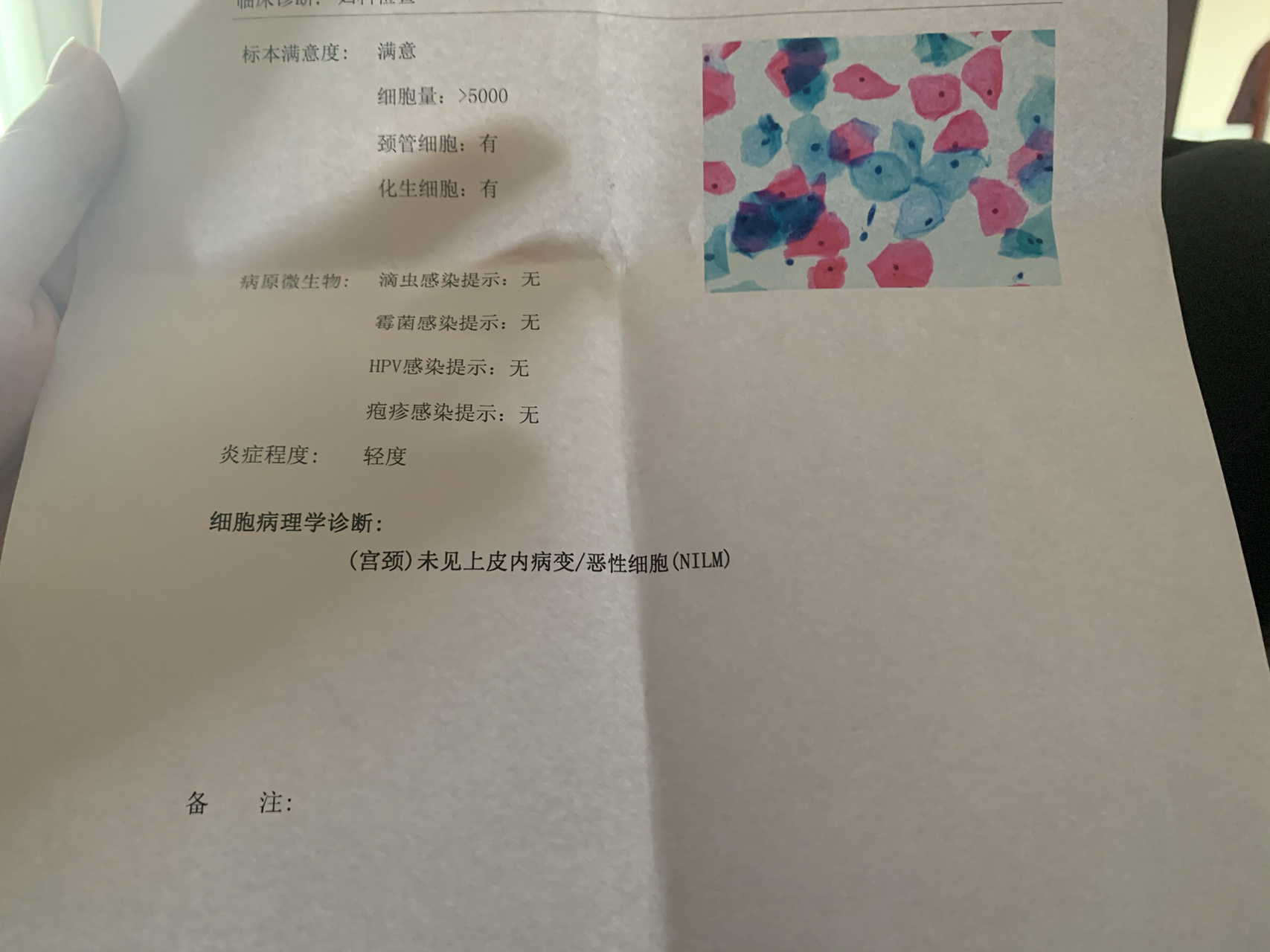 hpv51阳性 集美们 我真的是头疼啊 人生中第一次检查就高危51阳性了